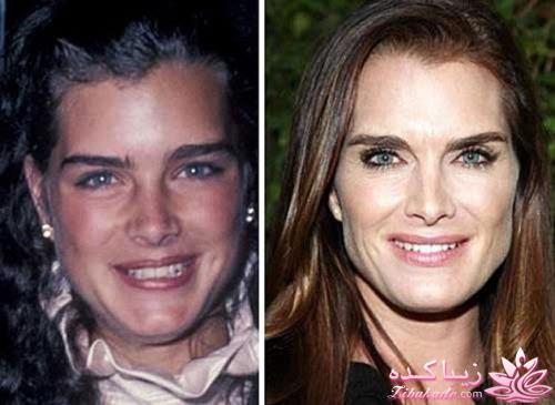 جراحی بینی - جراحی زیبایی